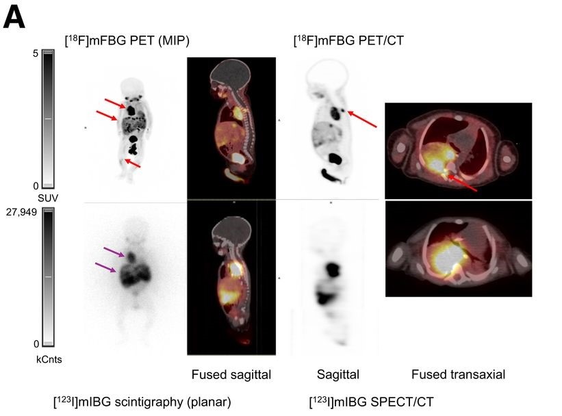 Imagen: PET/ULD CT con LAFOV [18F]MFBG (arriba) y [123I] MIBG gammagrafía con [123I]MIBG con imágenes SPECT/LDCT (abajo) de una niña de 7 semanas con neuroblastoma (foto cortesía del Journal of Nuclear Medicine)